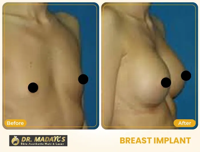 Breast implant before and after result 4 at Dr Madan Aesthetics
